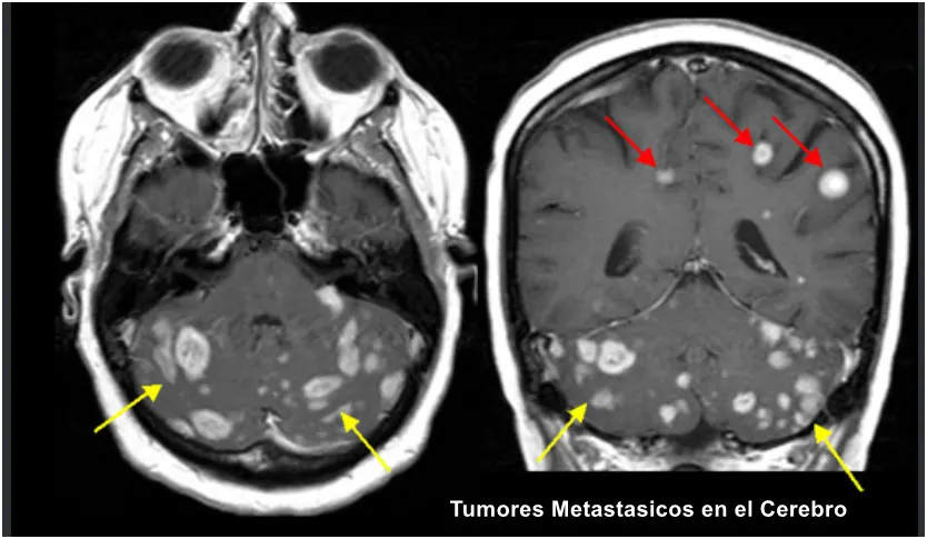 Tumores metastásicos en el cerebro